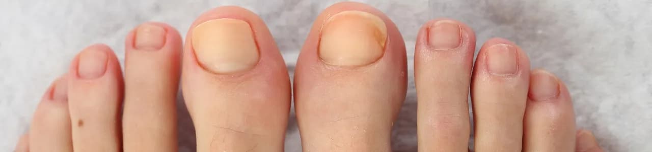 Grzybica stóp i paznokci: skuteczne metody, które przynoszą trwały efekt