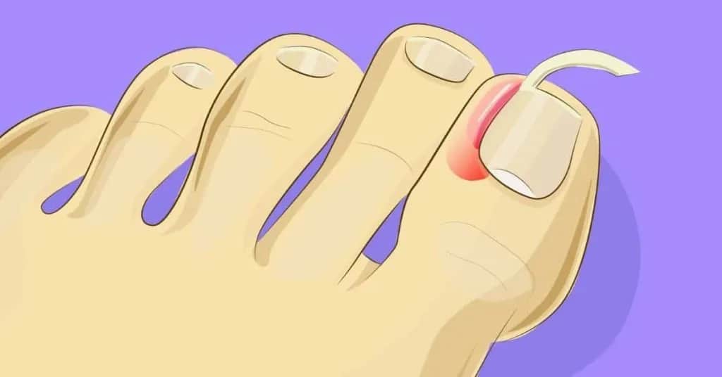 Jak skutecznie poradzić sobie z wrastającym paznokciem – domowe sposoby i leczenie